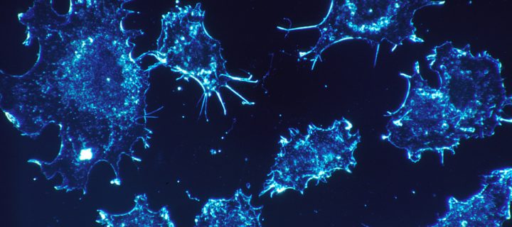 Übergewicht Risikofaktor für Krebs